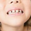 子どもの歯並びが悪い 乳歯の歯並びが悪い原因と対処法