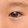【医師監修】子どもの逆さまつげで手術することも?!予防方法があるの?