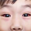 赤ちゃんの目が充血するのにはどんな理由があるの?対処法は?