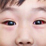 赤ちゃんの目が充血するのにはどんな理由があるの?対処法は?