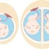 【医師監修】癒着胎盤の診断基準・症状・原因・治療・入院の必要性